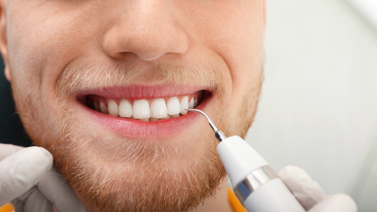 Detartrasi: le domande più frequenti