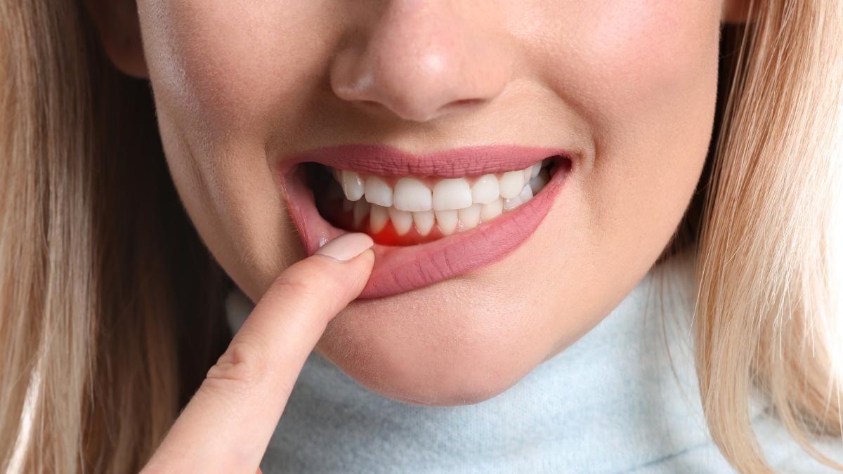 Gengive infiammate: cause e rimedi