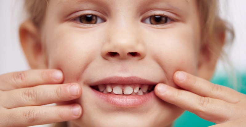 Le agenesie dentali nei bambini: come, quando e perché?